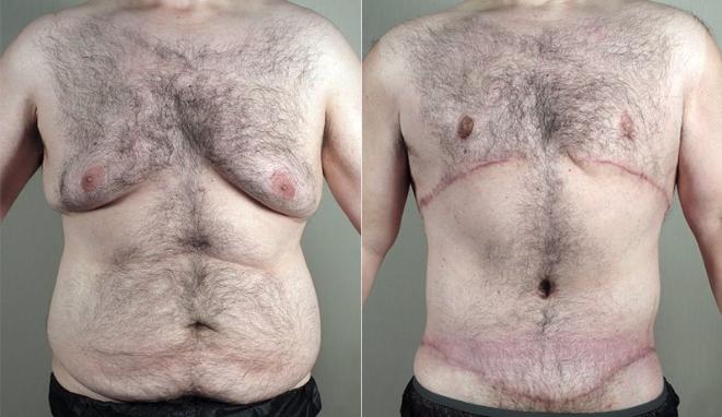 Body Lift Case 673 Before & After View #1 | Paramus, NJ | Parker Center for Plastic Surgery