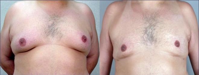 Gynecomastia Surgery Case 942 Before & After View #5 | Paramus, NJ | Parker Center for Plastic Surgery