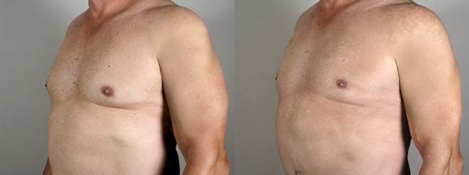 Gynecomastia Surgery Case 944 Before & After View #5 | Paramus, NJ | Parker Center for Plastic Surgery