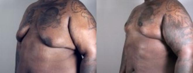 Liposuction Case 945 Before & After View #5 | Paramus, NJ | Parker Center for Plastic Surgery