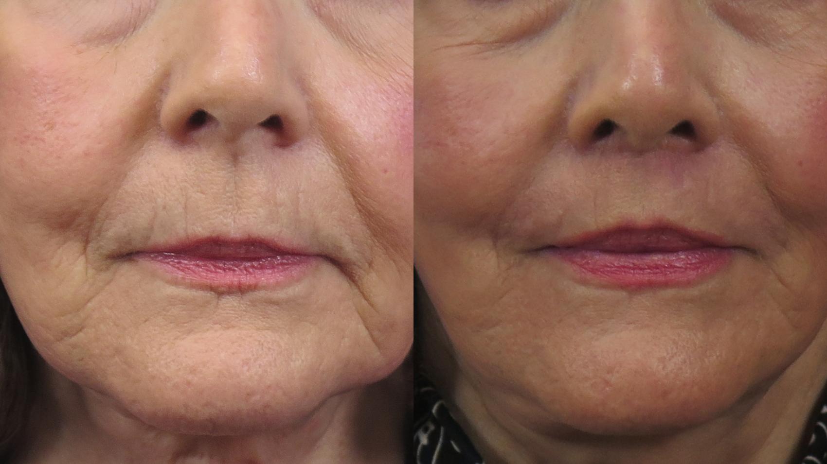 Lip Lift Case 1617 Before & After Front | Paramus, New Jersey | Parker Center for Plastic Surgery