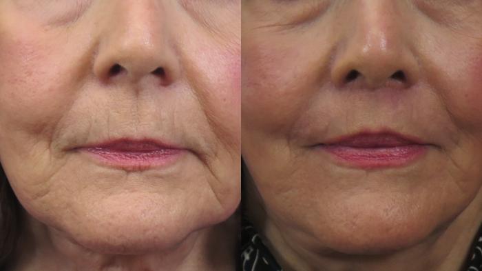 Lip Lift Case 1617 Before & After Front | Paramus, New Jersey | Parker Center for Plastic Surgery