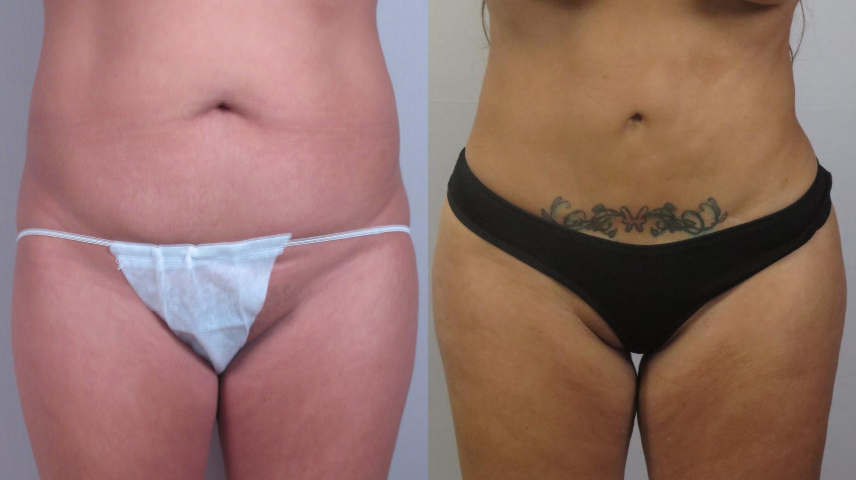Liposuction Case 1602 Before & After Front | Paramus, New Jersey | Parker Center for Plastic Surgery