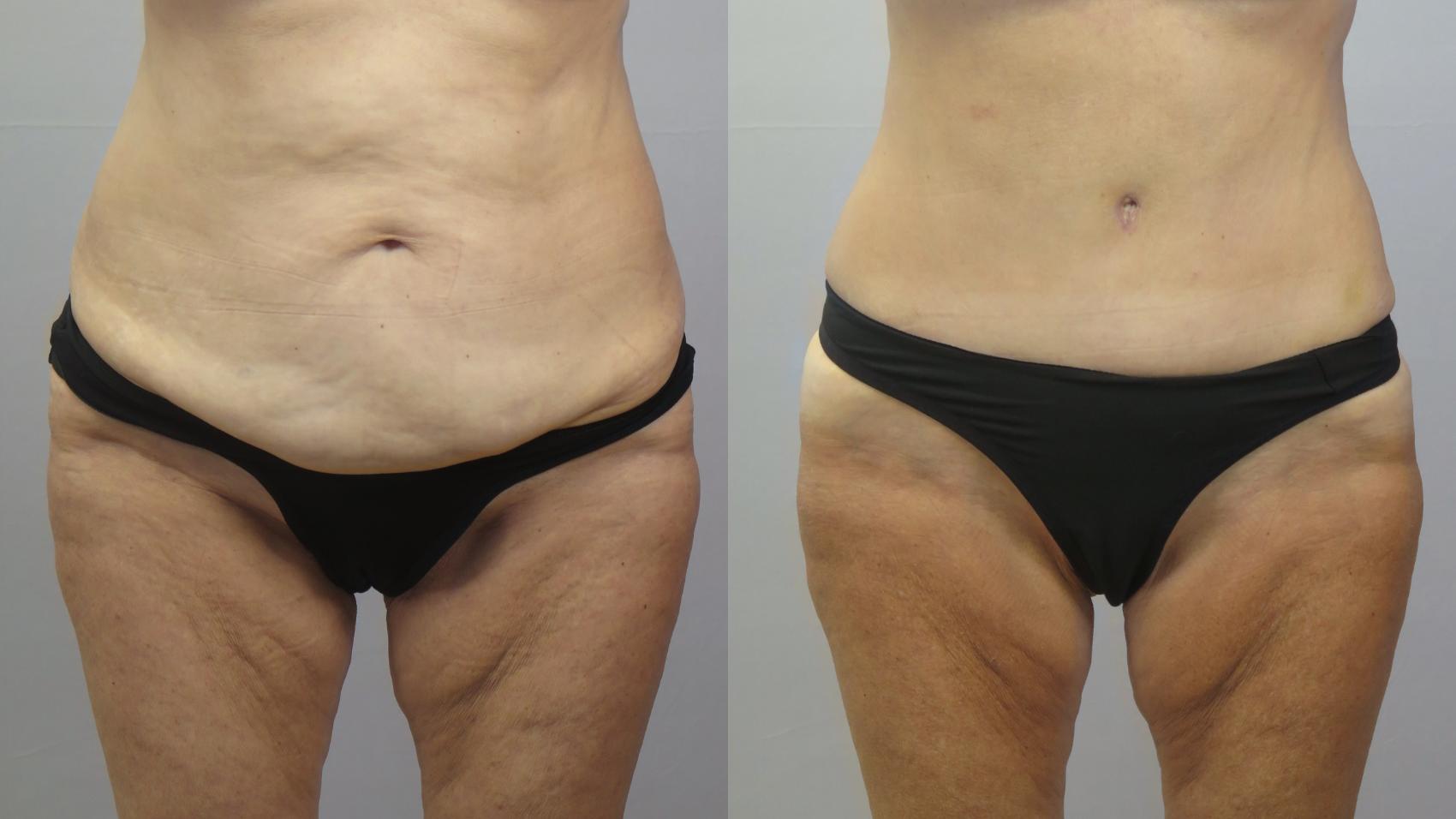 Liposuction Case 1621 Before & After Front | Paramus, New Jersey | Parker Center for Plastic Surgery
