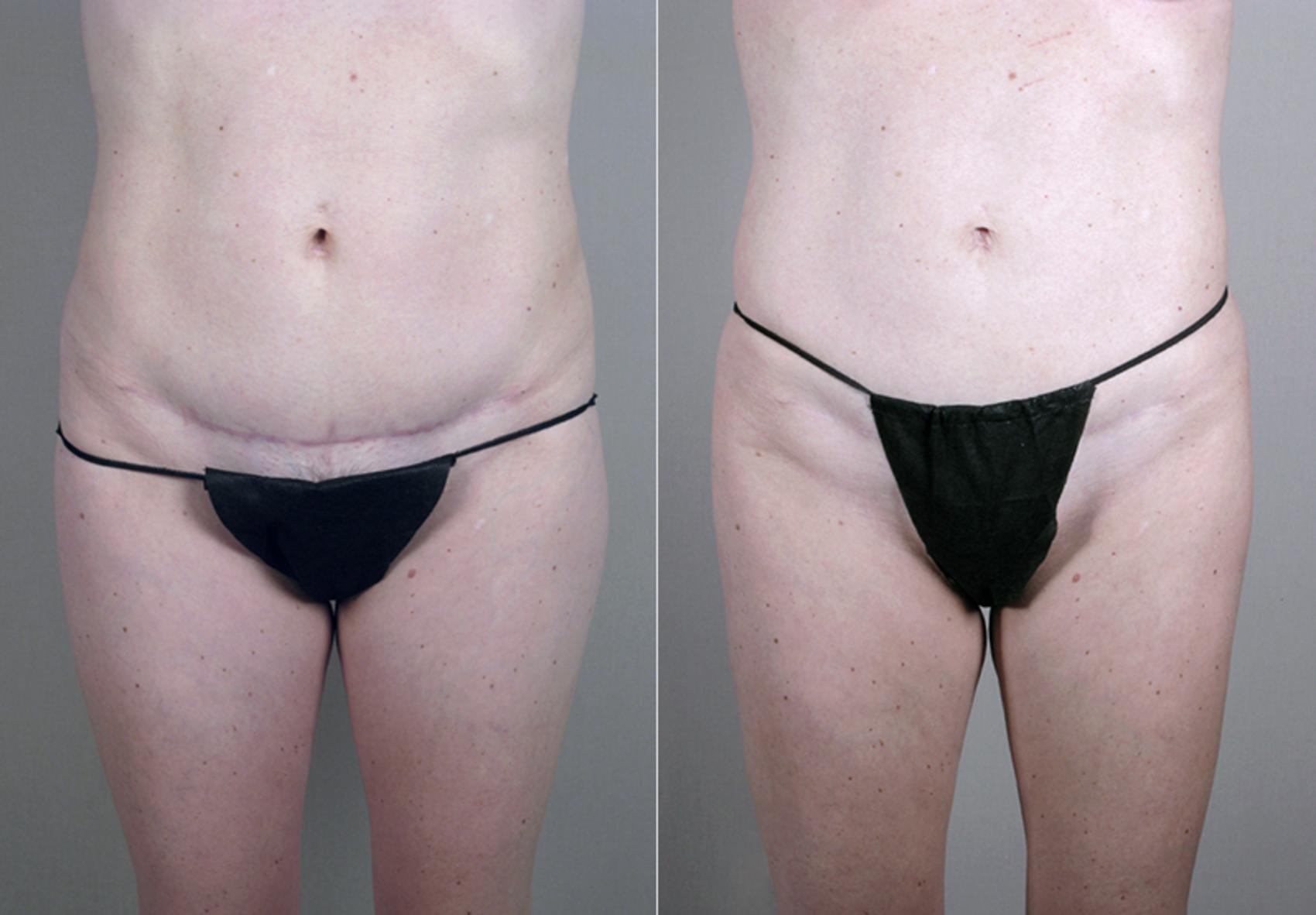 Liposuction Case 384 Before & After View #3 | Paramus, NJ | Parker Center for Plastic Surgery
