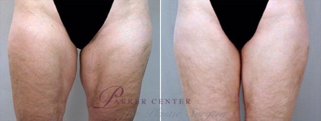Liposuction Case 757 Before & After View #1 | Paramus, NJ | Parker Center for Plastic Surgery