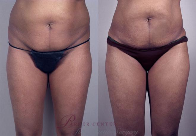 Liposuction Case 775 Before & After View #1 | Paramus, NJ | Parker Center for Plastic Surgery