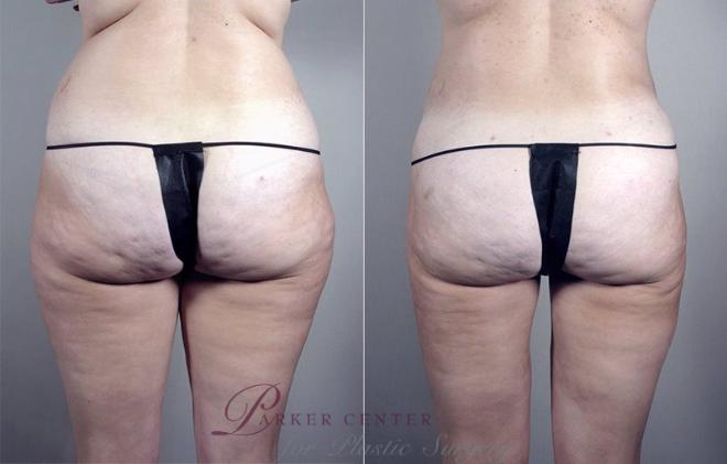 Liposuction Case 791 Before & After View #1 | Paramus, NJ | Parker Center for Plastic Surgery