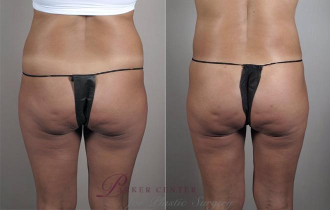 Liposuction Case 799 Before & After View #1 | Paramus, NJ | Parker Center for Plastic Surgery