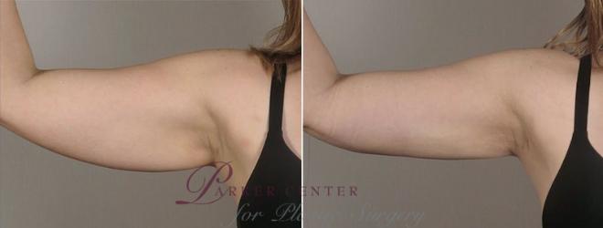 Liposuction Case 803 Before & After View #1 | Paramus, NJ | Parker Center for Plastic Surgery