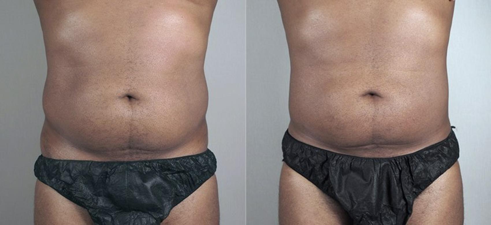 Liposuction Case 804 Before & After View #1 | Paramus, NJ | Parker Center for Plastic Surgery