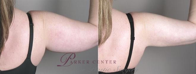 脂肪吸引症例 928 Before After View #5 | Paramus, NJ | Parker Center for Plastic Surgery