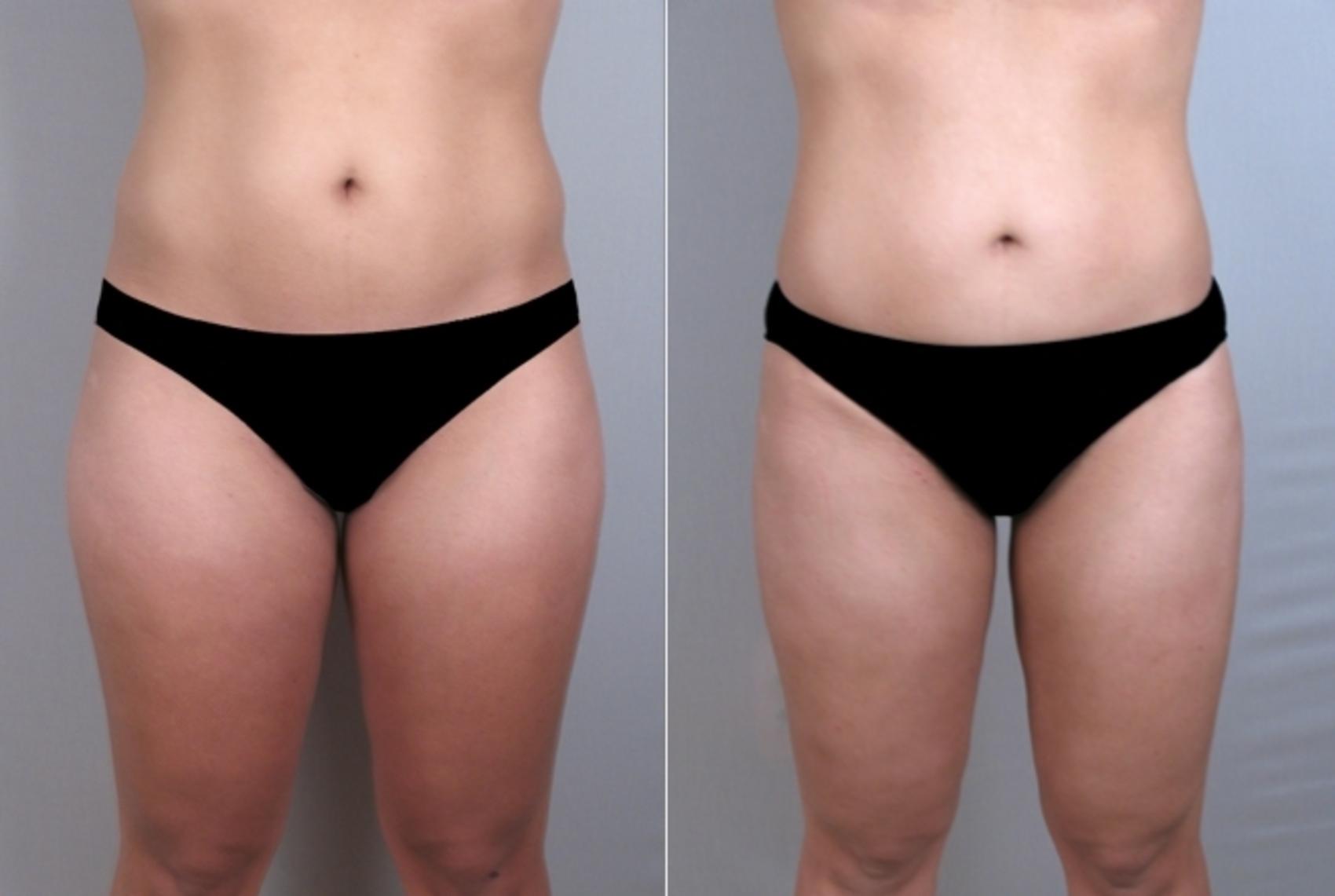Liposuction Case 929 Before & After View #5 | Paramus, NJ | Parker Center for Plastic Surgery