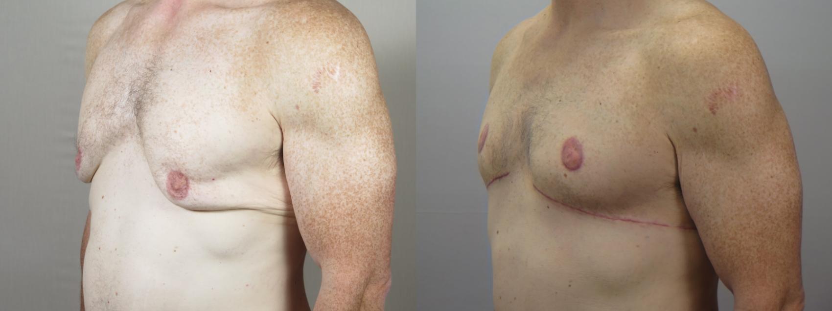 Male Breast Reduction Case 1570 Before & After Left Oblique | Paramus, New Jersey | Parker Center for Plastic Surgery