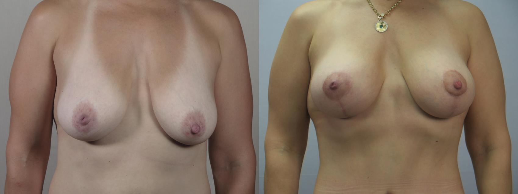 Mommy Makeover Case 1554 Before & After Front | Paramus, New Jersey | Parker Center for Plastic Surgery