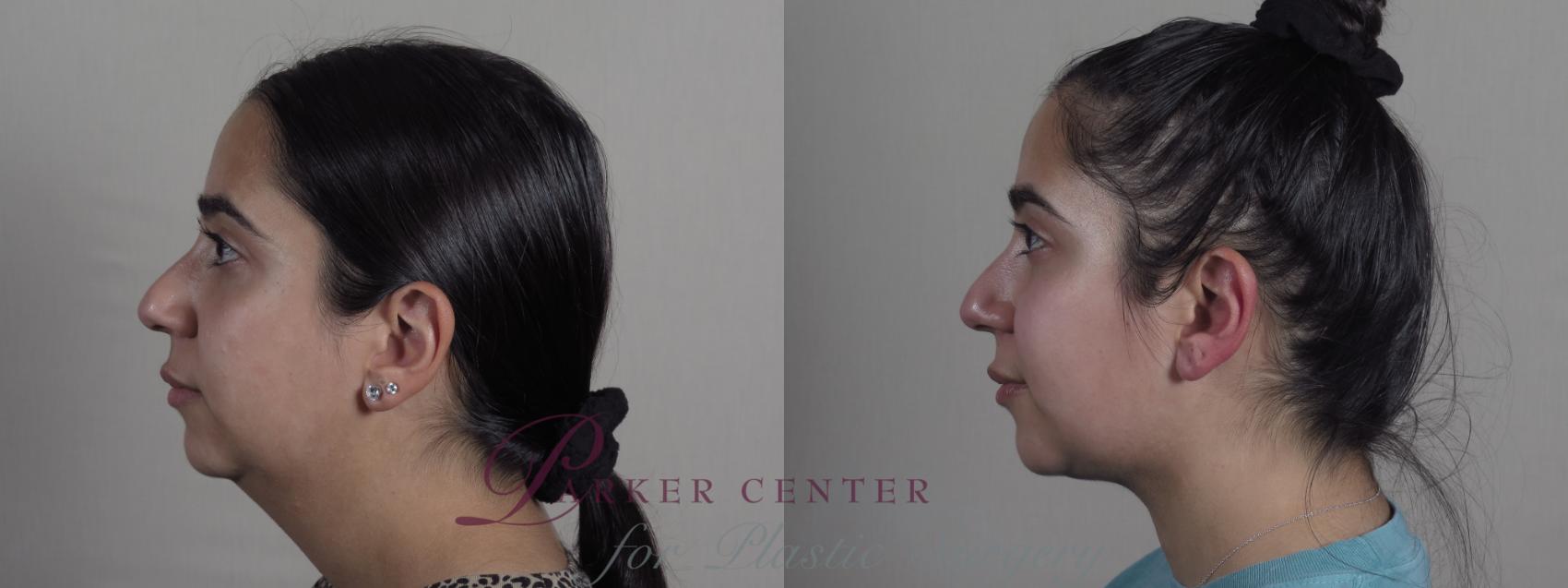 Neck Contouring Case 1215 Before & After View #1  | Paramus, NJ | Parker Center for Plastic Surgery