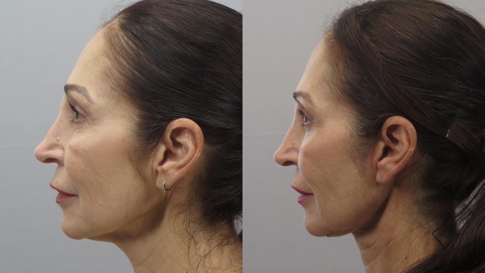 Neck Contouring Case 1579 Before & After Left Side | Paramus, New Jersey | Parker Center for Plastic Surgery