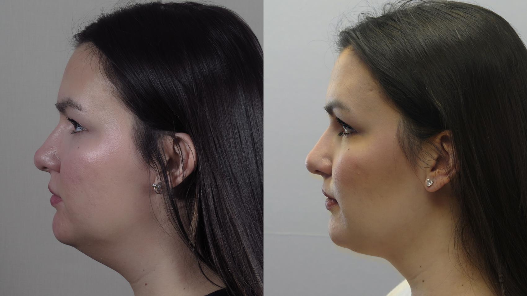 Neck Contouring Case 1581 Before & After Left Side | Paramus, New Jersey | Parker Center for Plastic Surgery