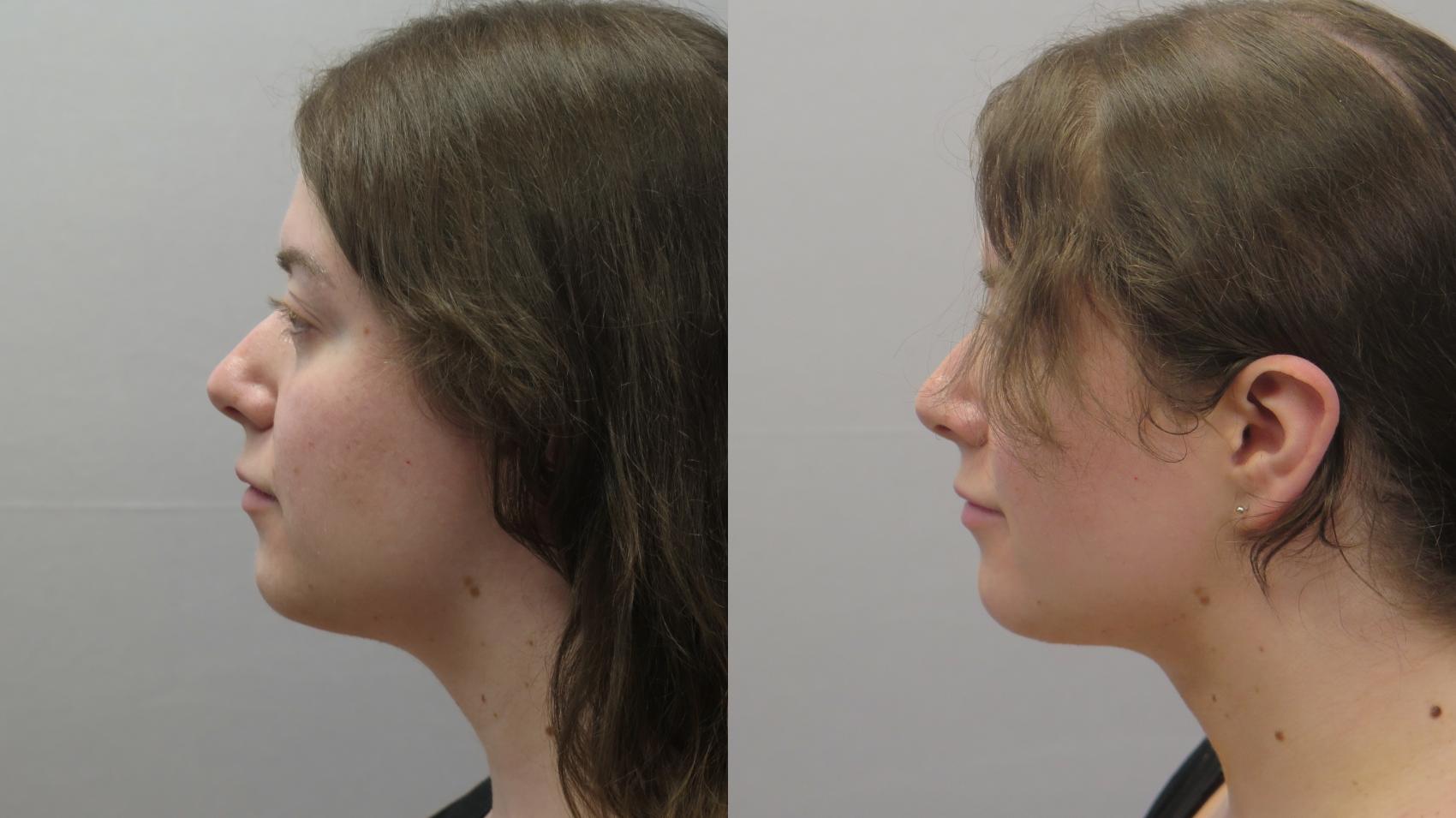 Neck Contouring Case 1616 Before & After Left Side | Paramus, New Jersey | Parker Center for Plastic Surgery