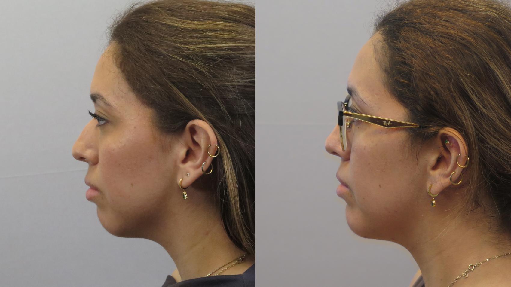 Neck Contouring Case 1625 Before & After Left Side | Paramus, New Jersey | Parker Center for Plastic Surgery