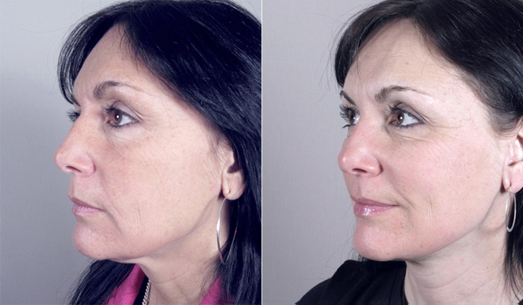 Neck Contouring Case 208 Before & After View #1 | Paramus, NJ | Parker Center for Plastic Surgery