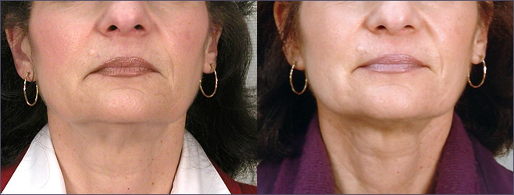 Neck Contouring Case 210 Before & After View #1 | Paramus, NJ | Parker Center for Plastic Surgery