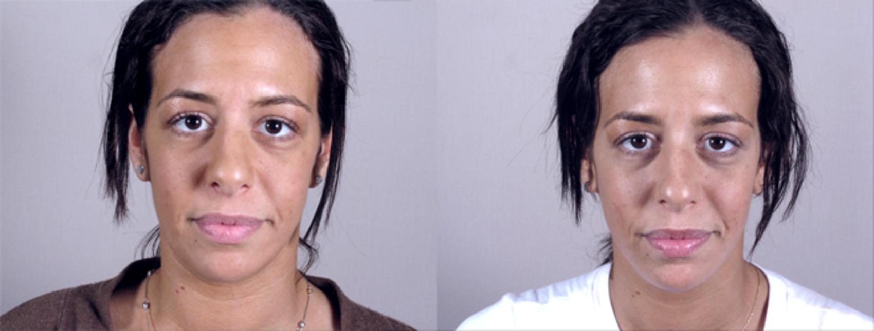 Neck Contouring Case 213 Before & After View #1 | Paramus, NJ | Parker Center for Plastic Surgery