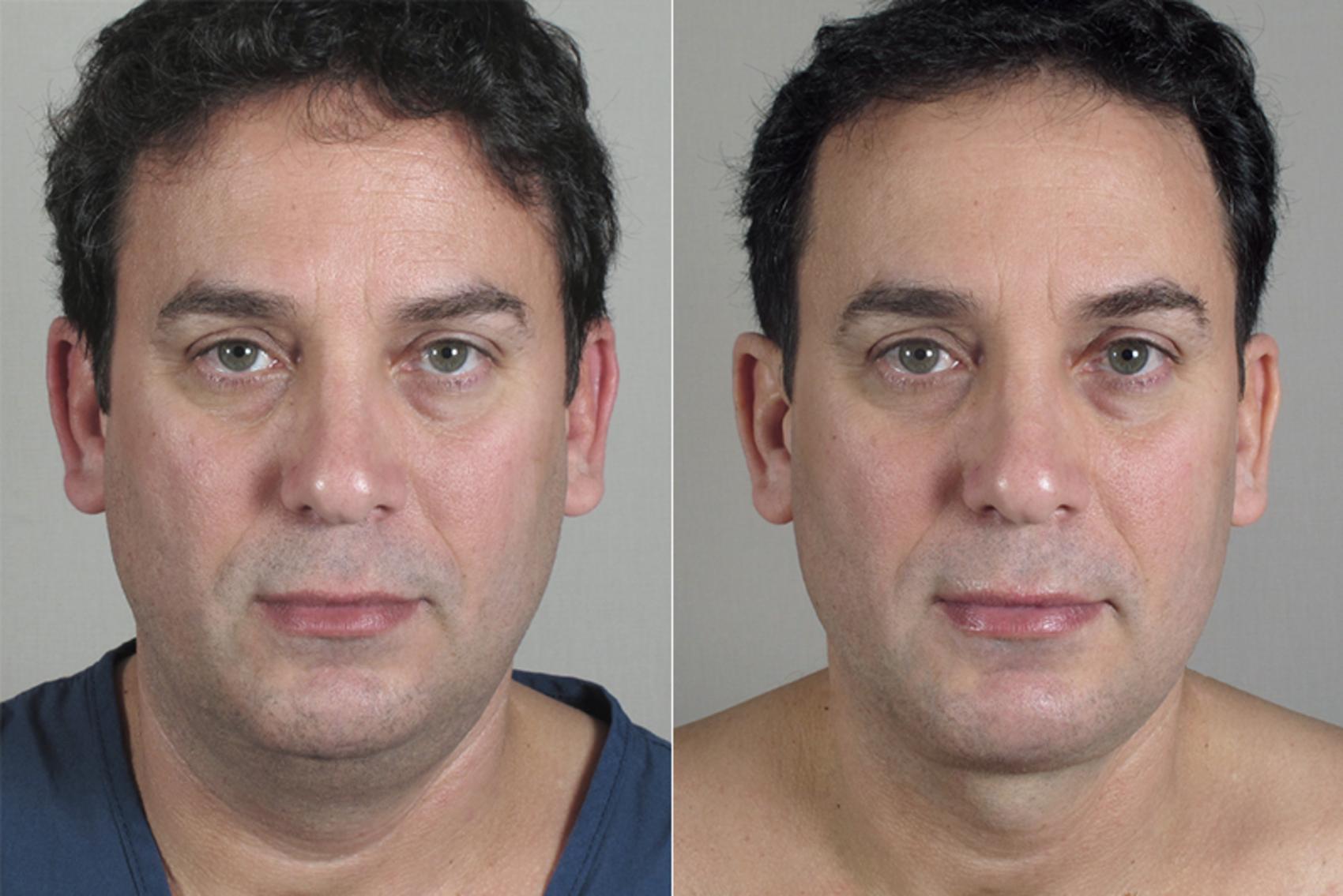 Neck Contouring Case 215 Before & After View #1 | Paramus, NJ | Parker Center for Plastic Surgery