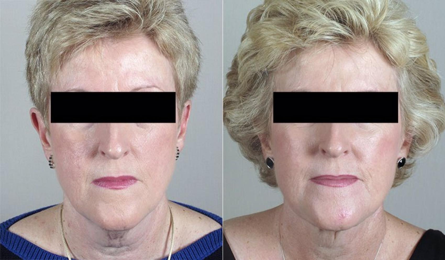 Neck Contouring Case 225 Before & After View #1 | Paramus, NJ | Parker Center for Plastic Surgery