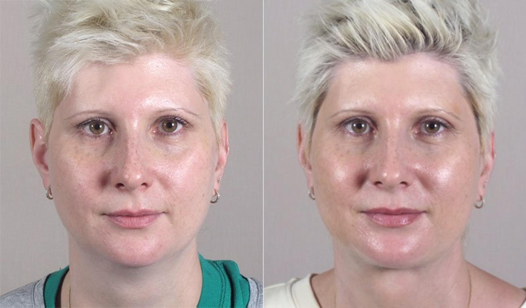 Neck Contouring Case 226 Before & After View #1 | Paramus, NJ | Parker Center for Plastic Surgery