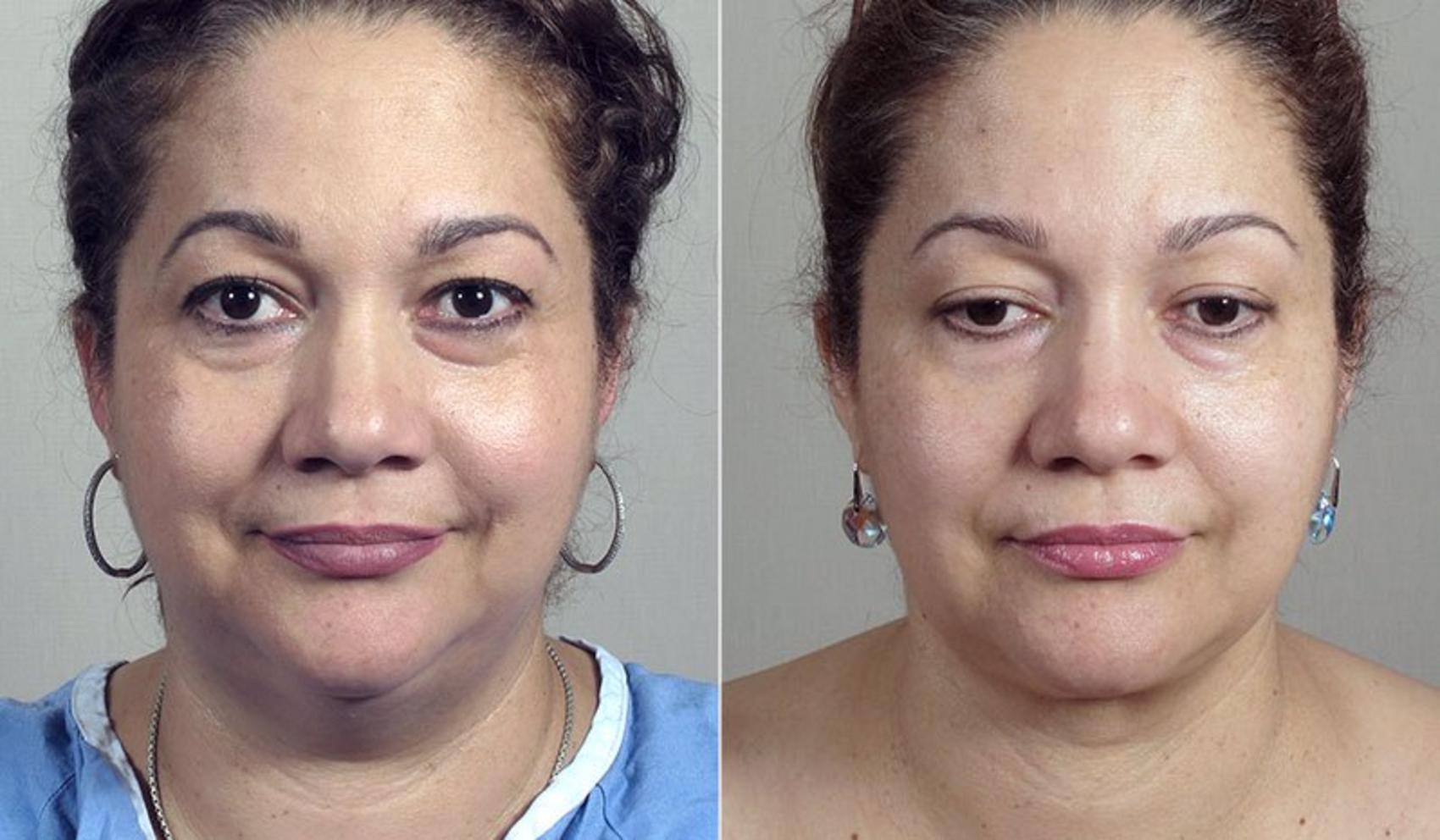 Neck Contouring Case 229 Before & After View #1 | Paramus, NJ | Parker Center for Plastic Surgery