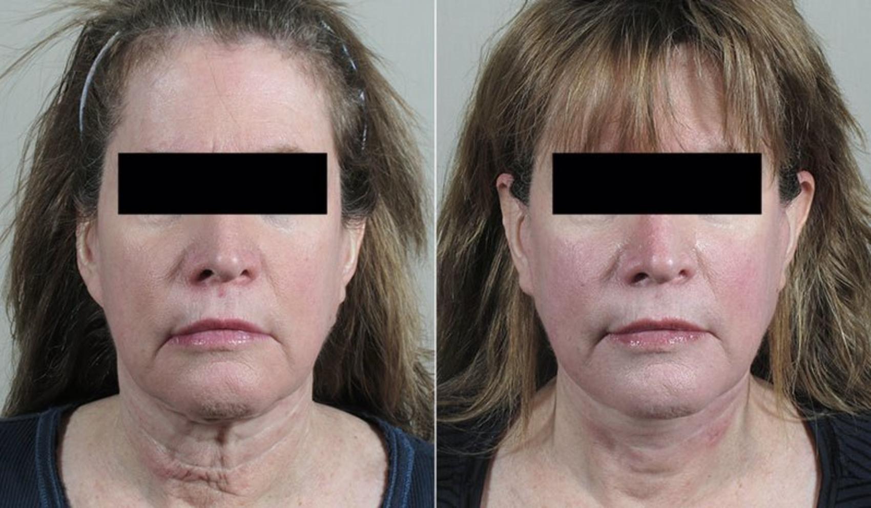 Neck Contouring Case 231 Before & After View #1 | Paramus, NJ | Parker Center for Plastic Surgery