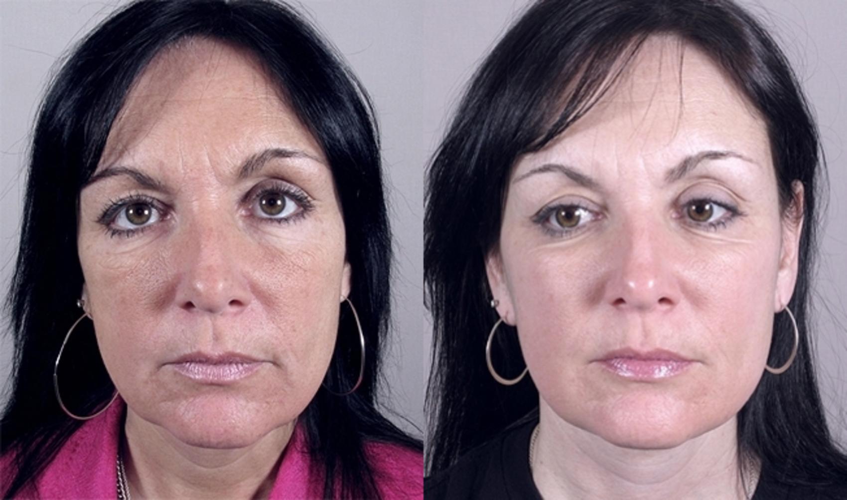 Neck Contouring Case 916 Before & After View #5 | Paramus, NJ | Parker Center for Plastic Surgery
