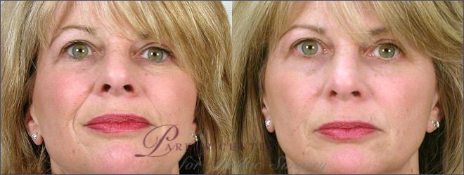 Nonsurgical Face Procedures Case 269 Before & After View #1 | Paramus, NJ | Parker Center for Plastic Surgery