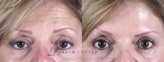 Nonsurgical Face Procedures Case 270 Before & After View #1 | Paramus, NJ | Parker Center for Plastic Surgery