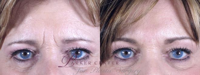 Nonsurgical Face Procedures Case 271 Before & After View #1 | Paramus, NJ | Parker Center for Plastic Surgery