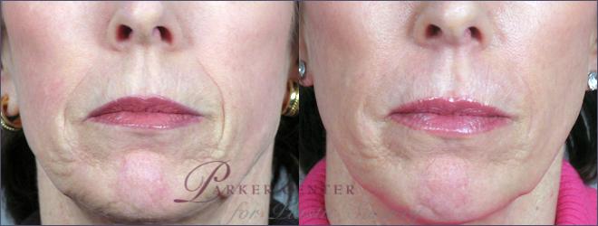 Nonsurgical Face Procedures Case 272 Before & After View #1 | Paramus, NJ | Parker Center for Plastic Surgery