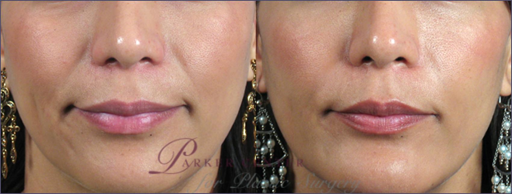 Nonsurgical Face Procedures Case 274 Before & After View #1 | Paramus, NJ | Parker Center for Plastic Surgery