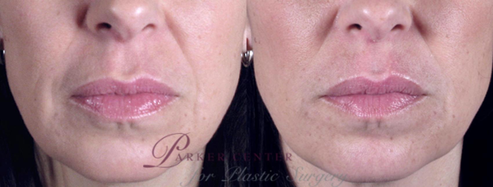 Nonsurgical Face Procedures Case 275 Before & After View #1 | Paramus, NJ | Parker Center for Plastic Surgery