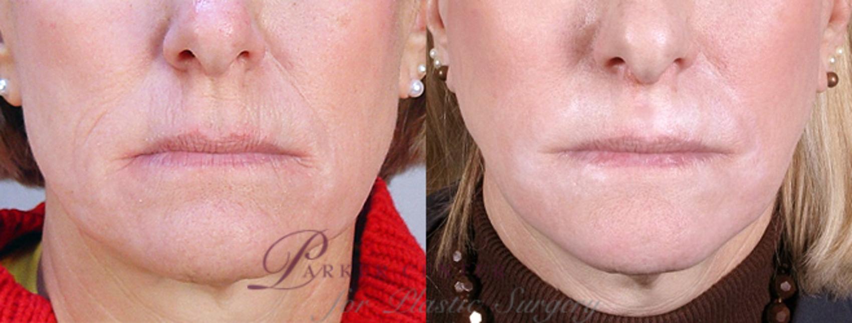 Nonsurgical Face Procedures Case 277 Before & After View #1 | Paramus, NJ | Parker Center for Plastic Surgery
