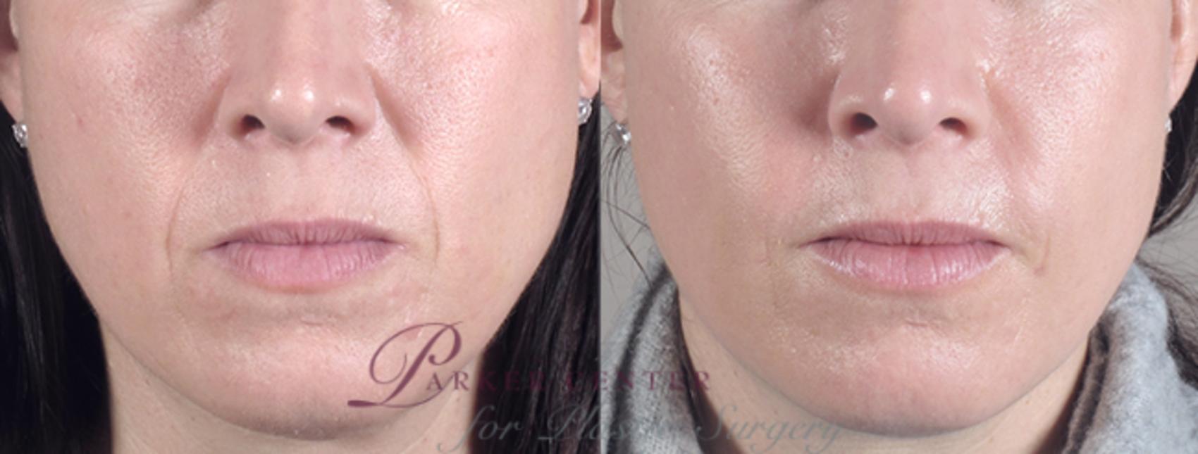 Nonsurgical Face Procedures Case 278 Before & After View #1 | Paramus, NJ | Parker Center for Plastic Surgery