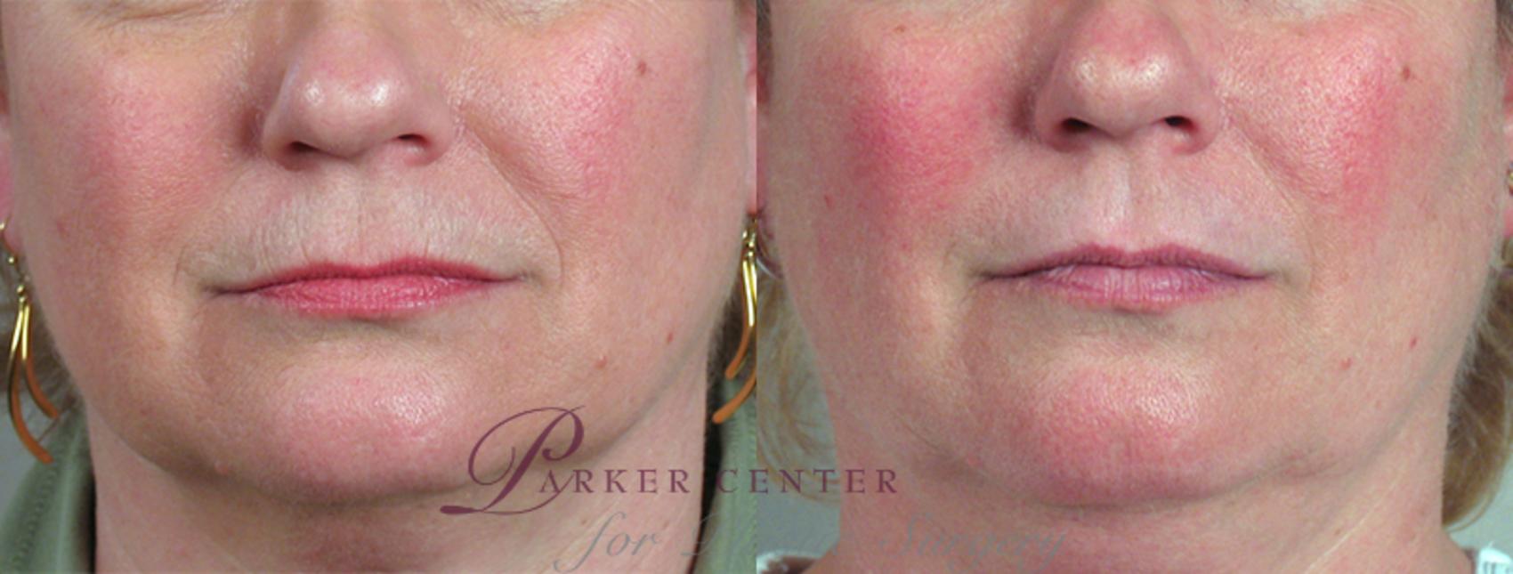 Nonsurgical Face Procedures Case 279 Before & After View #1 | Paramus, NJ | Parker Center for Plastic Surgery