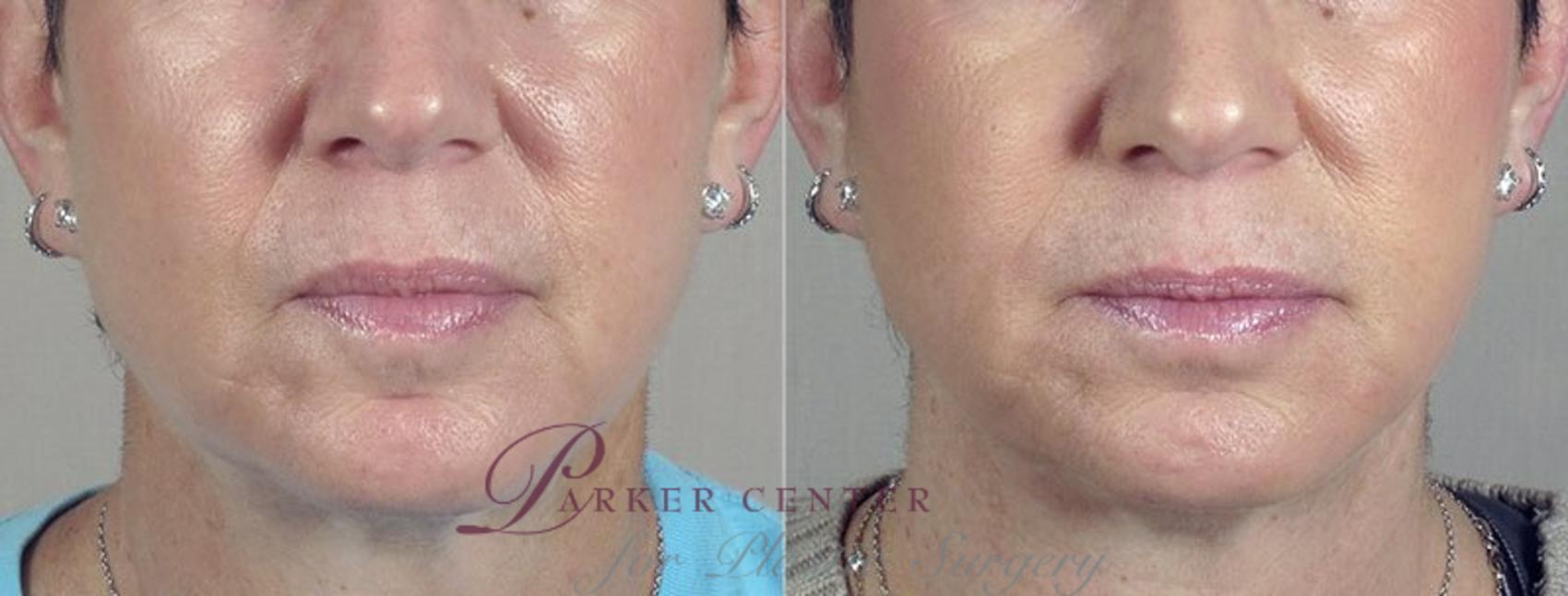 Nonsurgical Face Procedures Case 284 Before & After View #1 | Paramus, NJ | Parker Center for Plastic Surgery