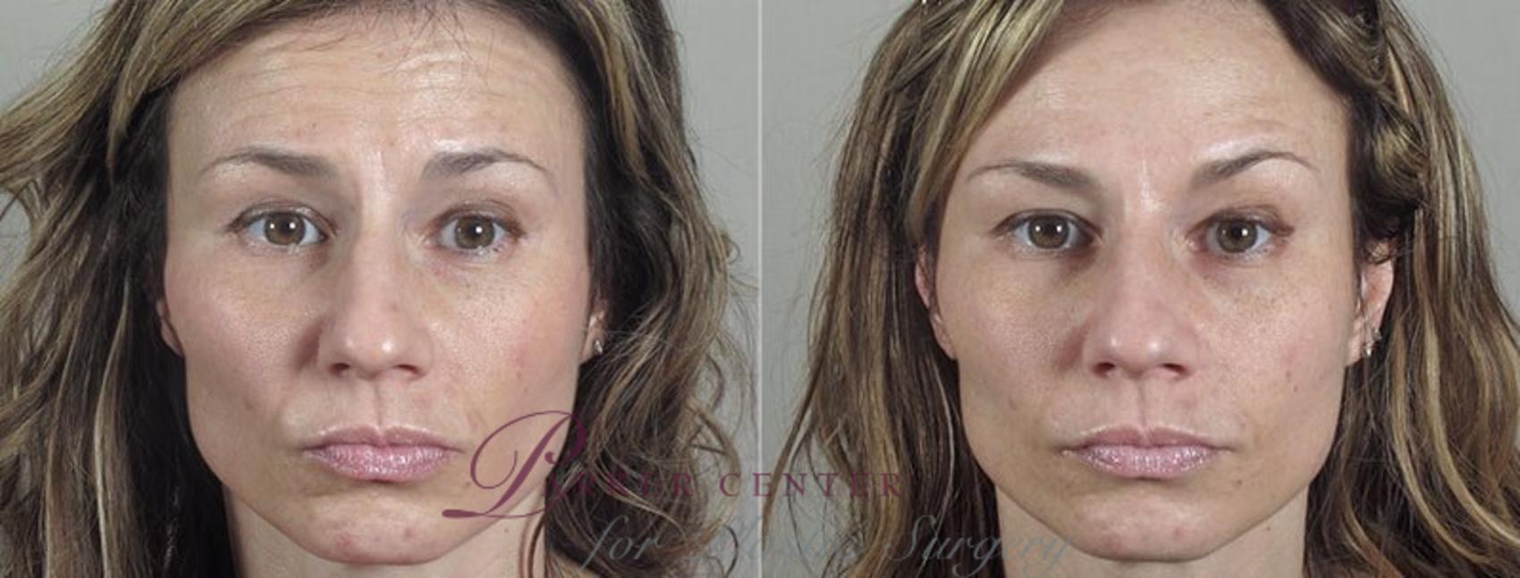 Nonsurgical Face Procedures Case 287 Before & After View #1 | Paramus, NJ | Parker Center for Plastic Surgery