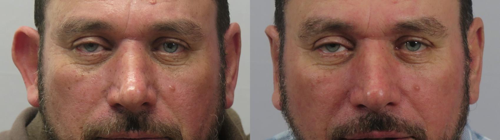 Otoplasty Case 1561 Before & After Front | Paramus, New Jersey | Parker Center for Plastic Surgery