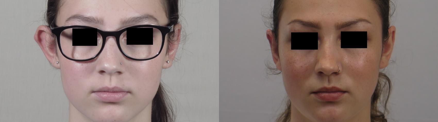 Otoplasty Case 1613 Before & After Front | Paramus, New Jersey | Parker Center for Plastic Surgery