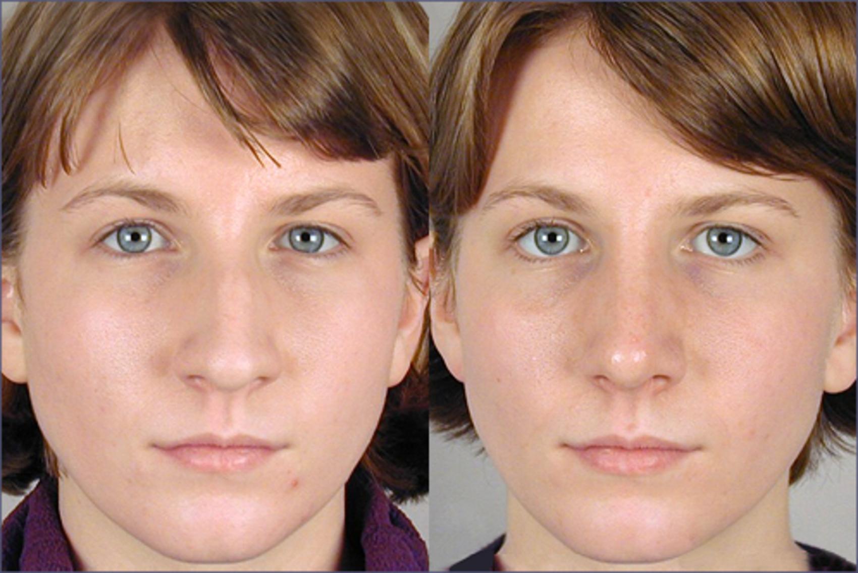 Rhinoplasty Case 119 Before & After View #1 | Paramus, NJ | Parker Center for Plastic Surgery