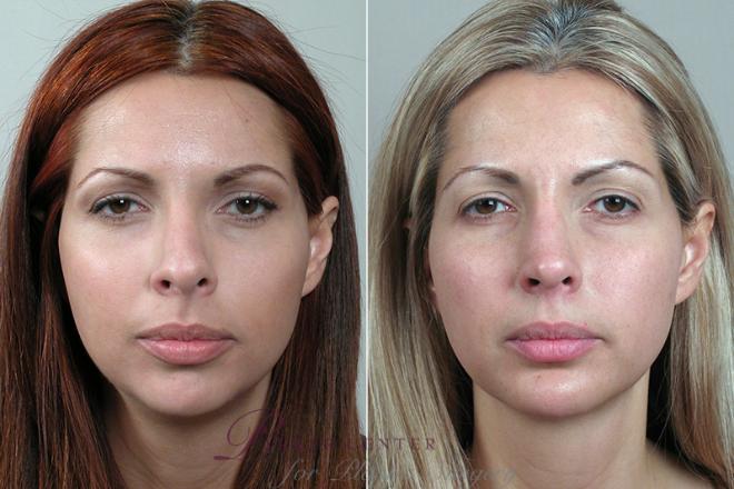 Rhinoplasty Case 125 Before & After View #1 | Paramus, NJ | Parker Center for Plastic Surgery