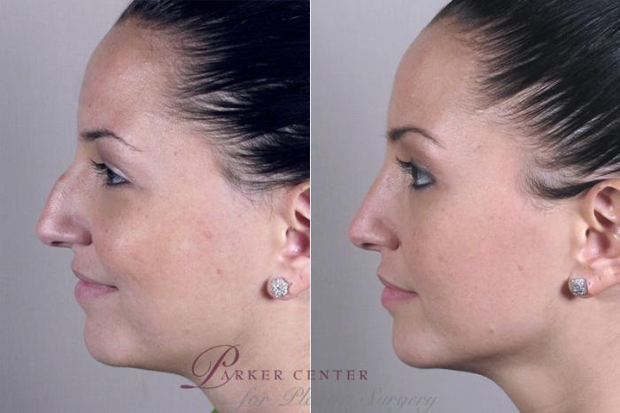 Rhinoplasty Case 143 Before & After View #2 | Paramus, NJ | Parker Center for Plastic Surgery