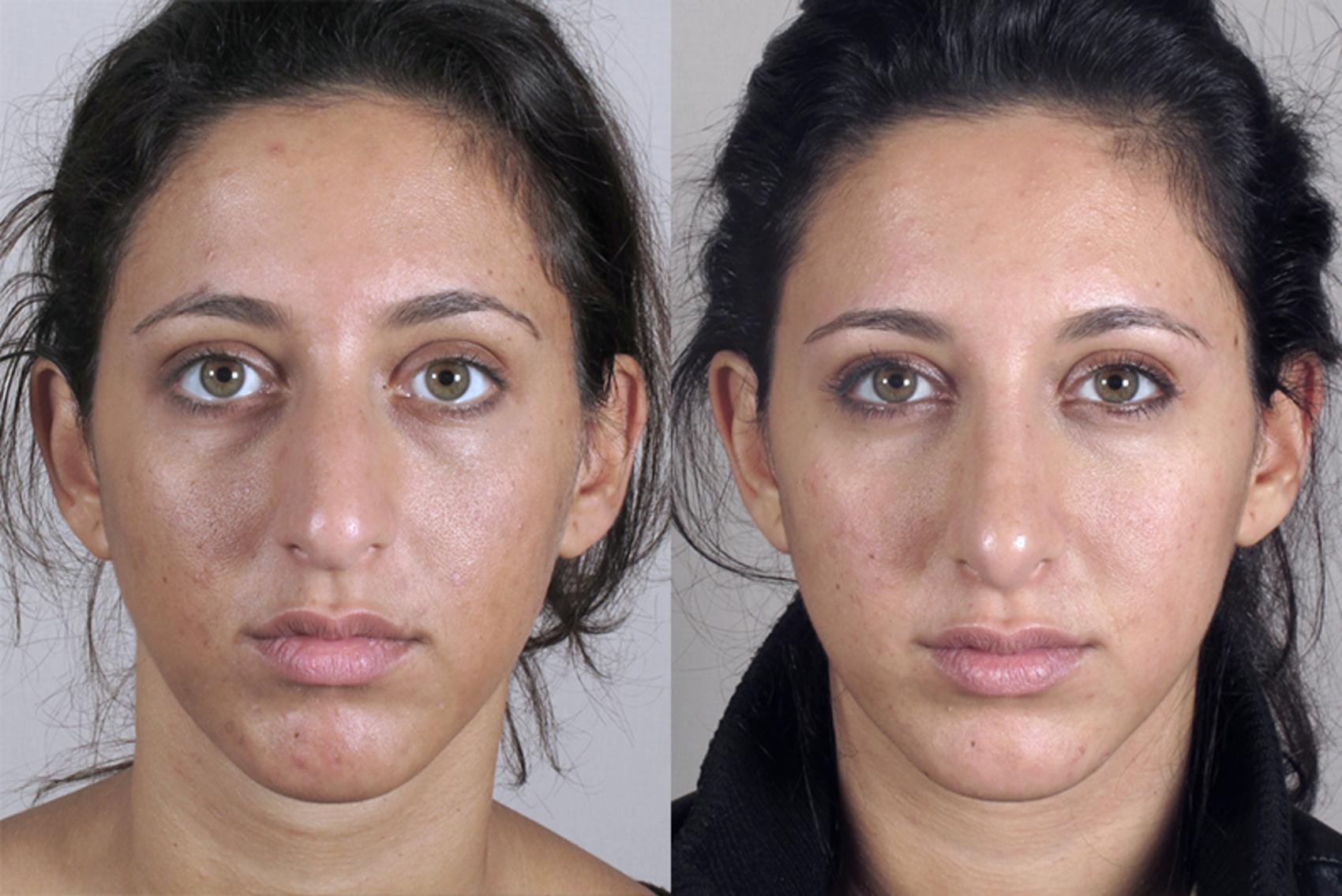 Rhinoplasty Case 149 Before & After View #1 | Paramus, NJ | Parker Center for Plastic Surgery
